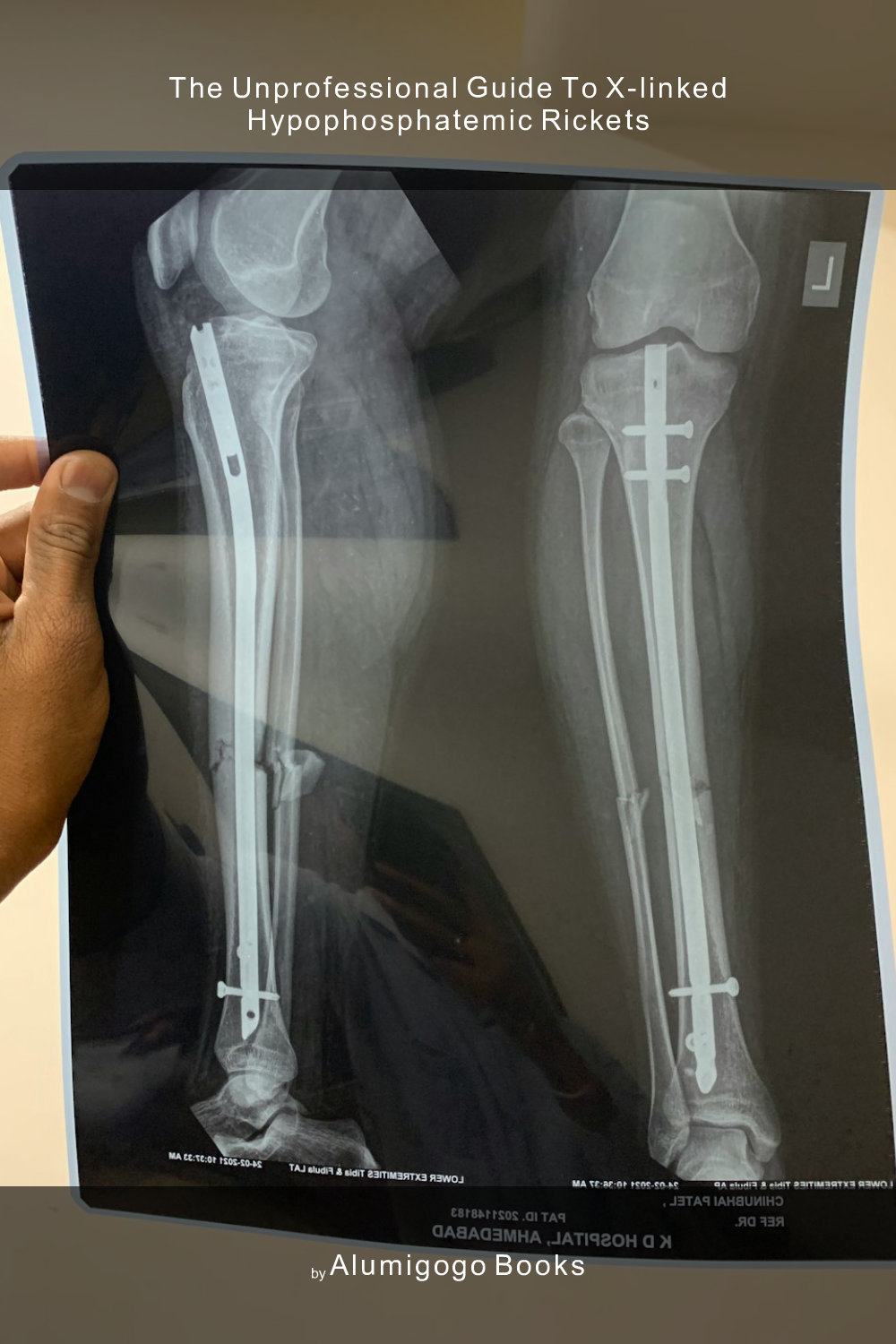 Cover of The Unprofessional Guide to X-linked hypophosphatemic rickets