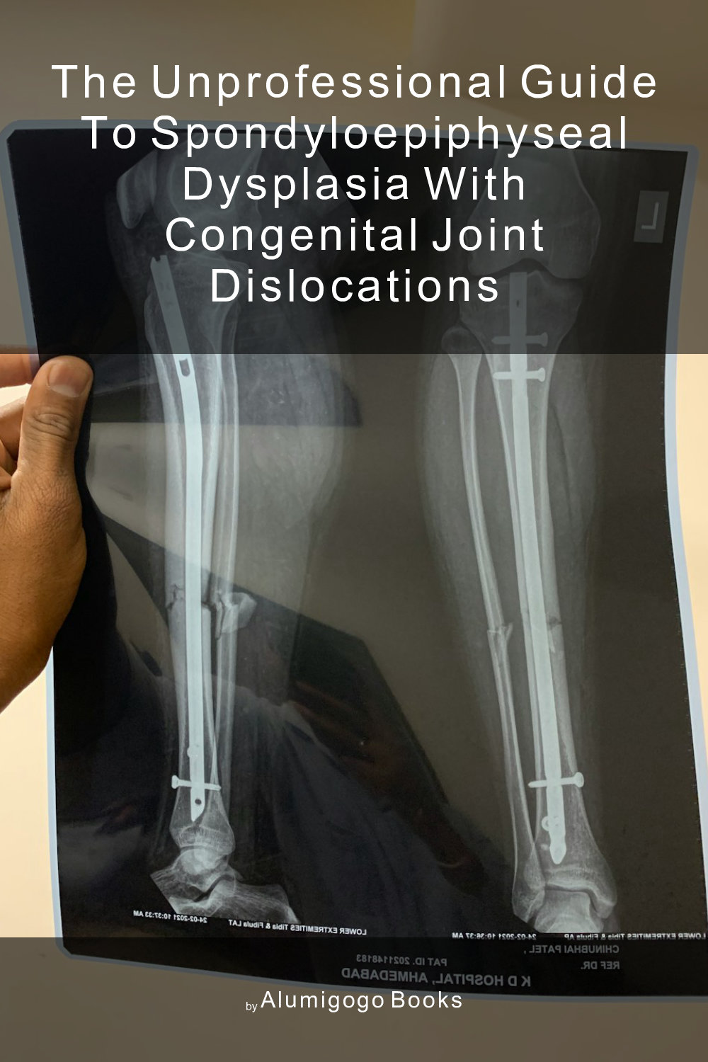 Cover of The Unprofessional Guide to spondyloepiphyseal dysplasia with congenital joint dislocations