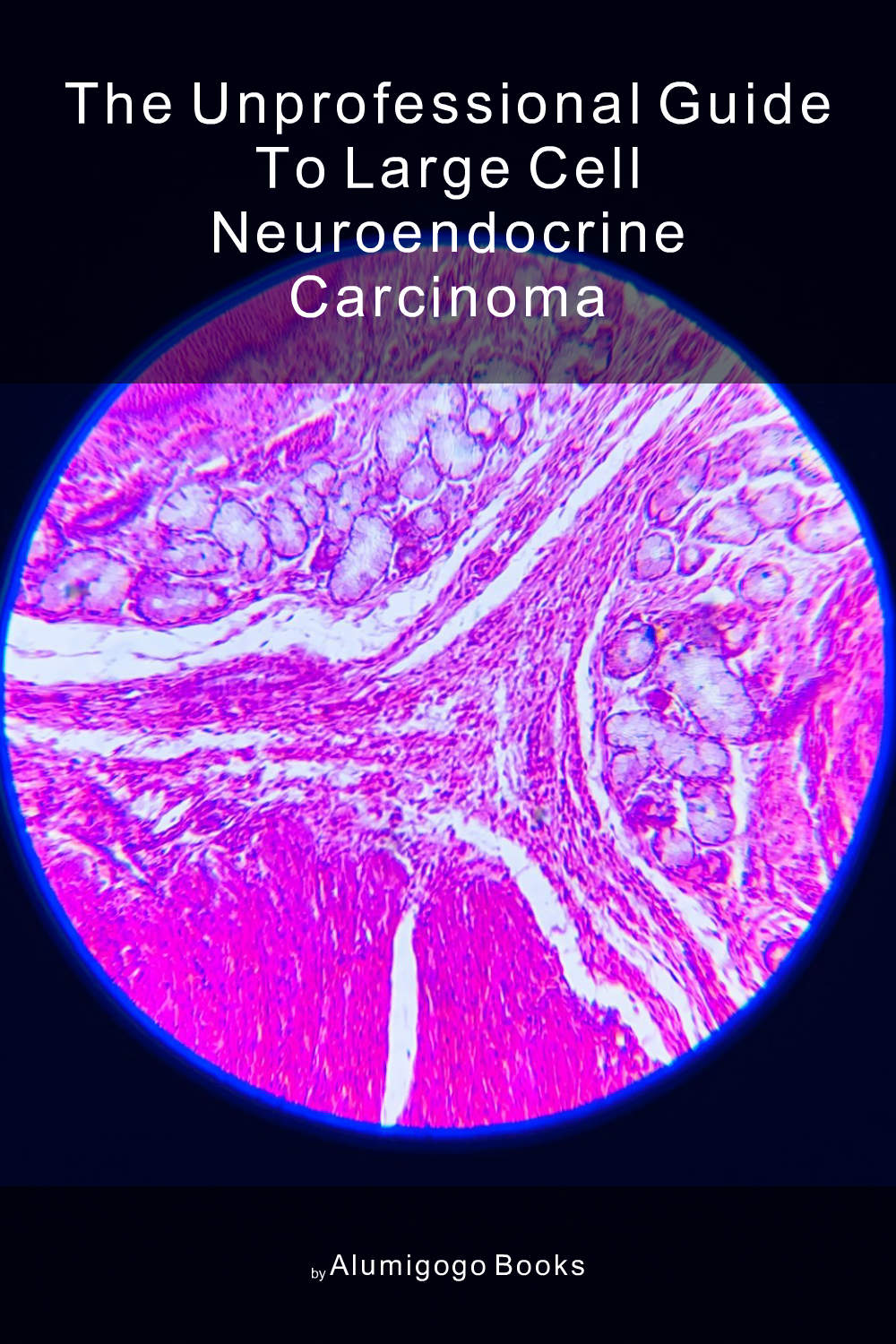 Cover of The Unprofessional Guide to large cell neuroendocrine carcinoma