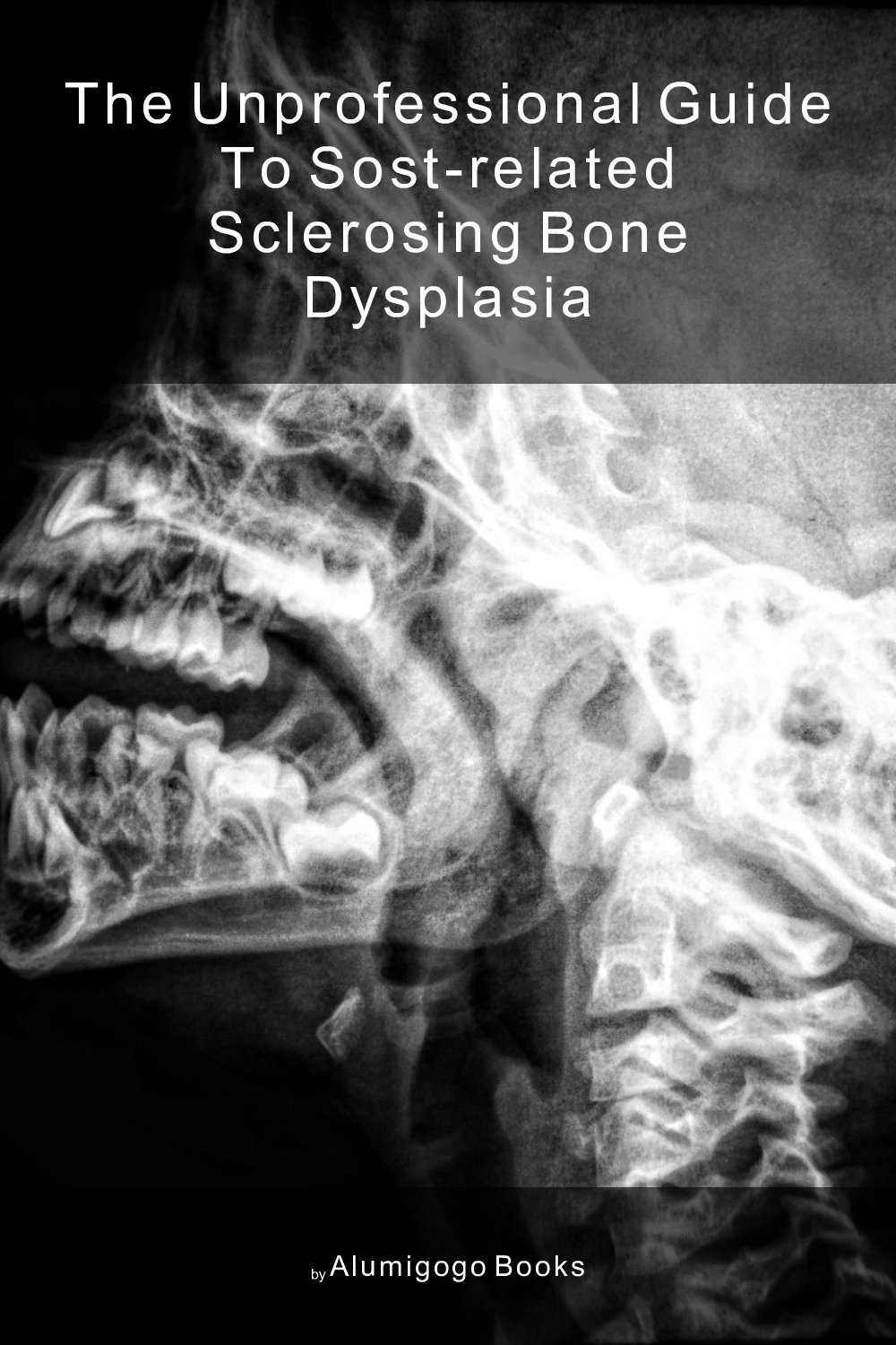 Cover of The Unprofessional Guide to SOST-related sclerosing bone dysplasia