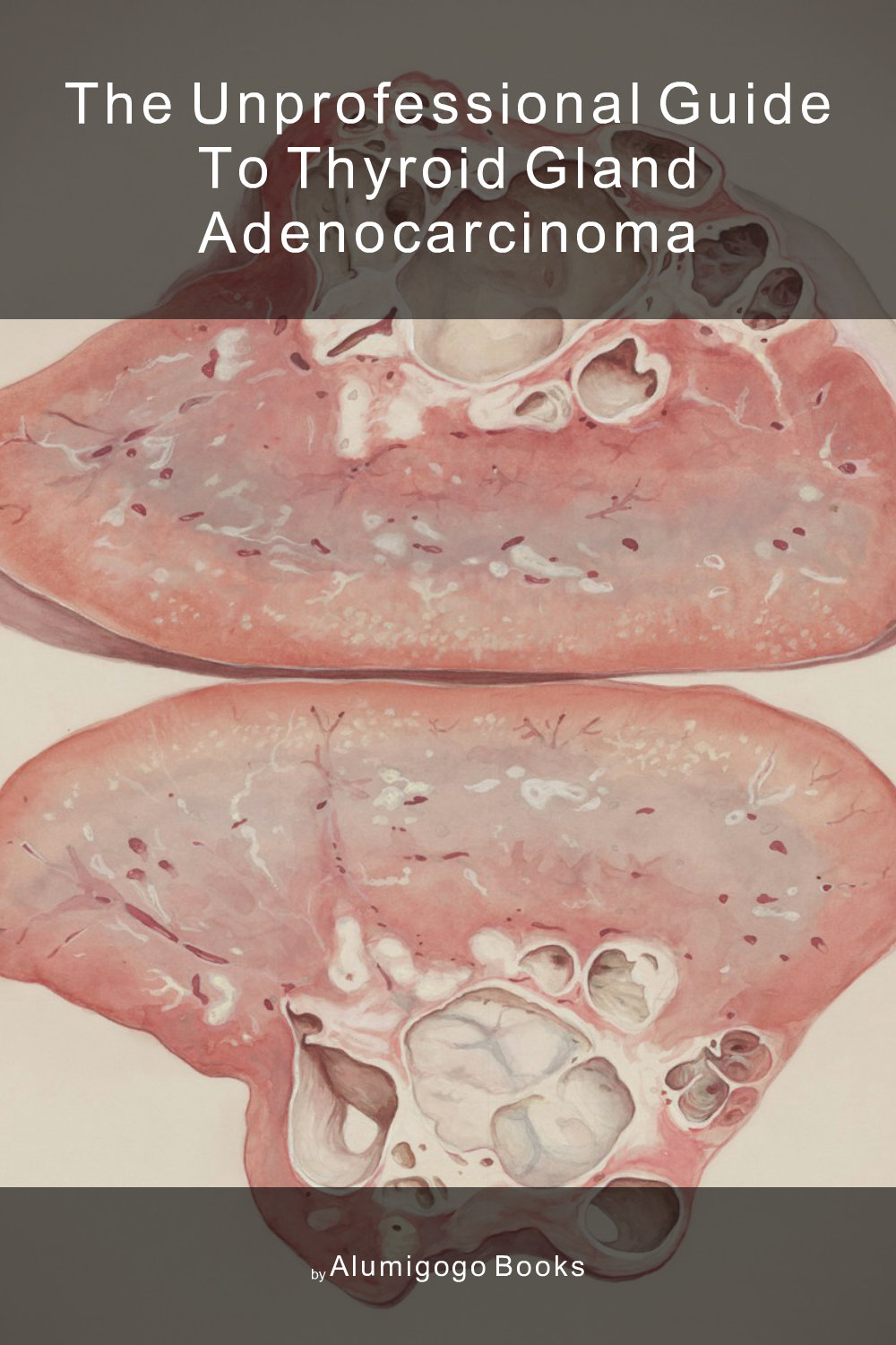 Cover of The Unprofessional Guide to thyroid gland adenocarcinoma