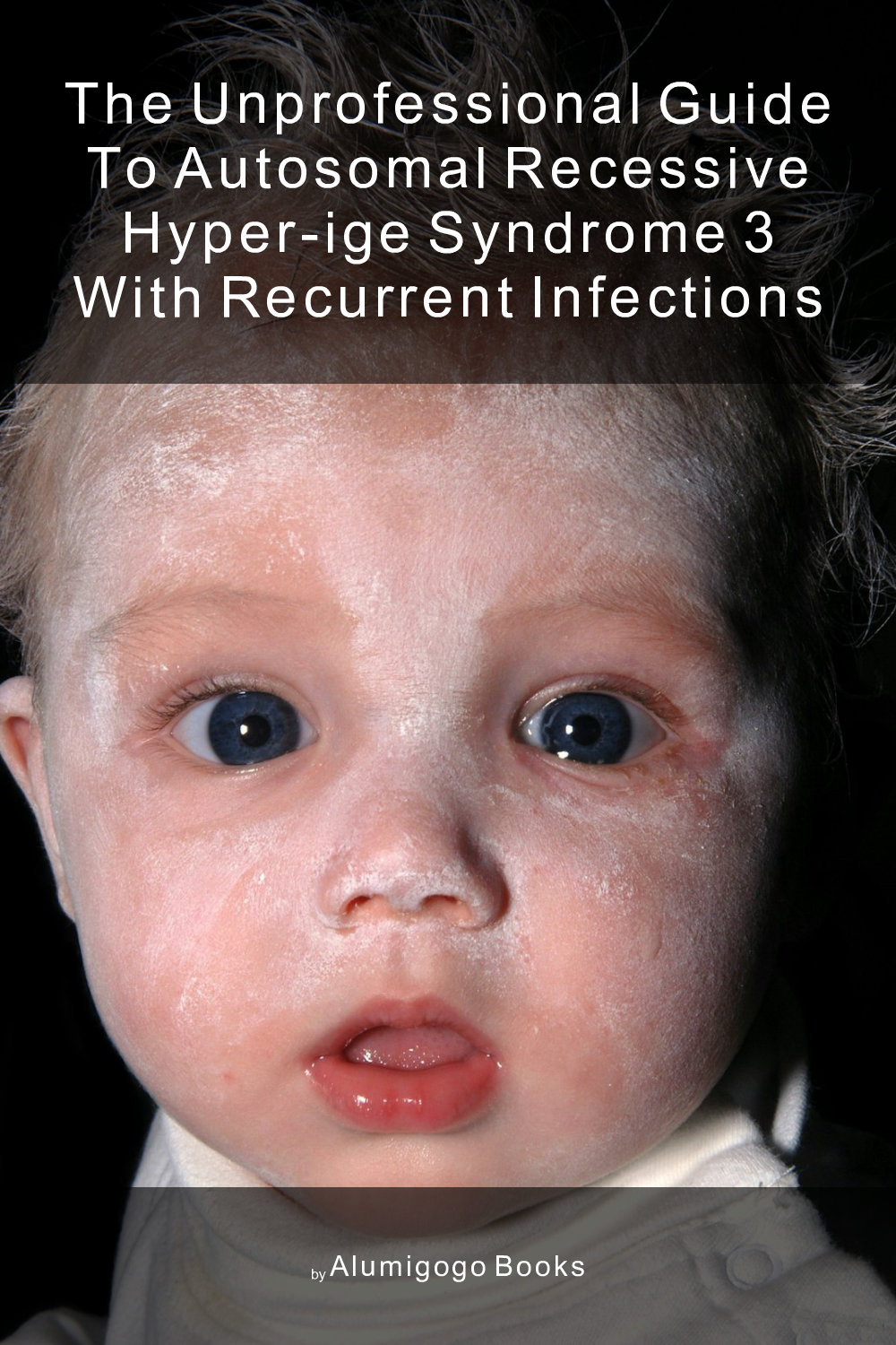 Cover of The Unprofessional Guide to autosomal recessive hyper-IgE syndrome 3 with recurrent infections