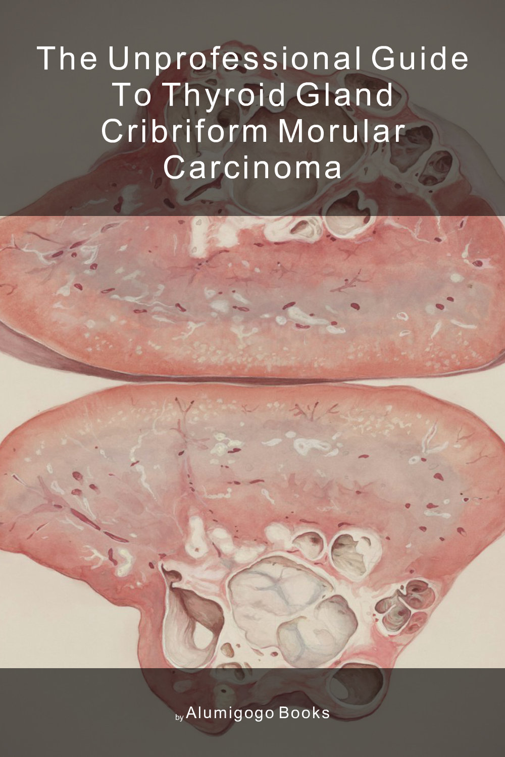 Cover of The Unprofessional Guide to thyroid gland cribriform morular carcinoma