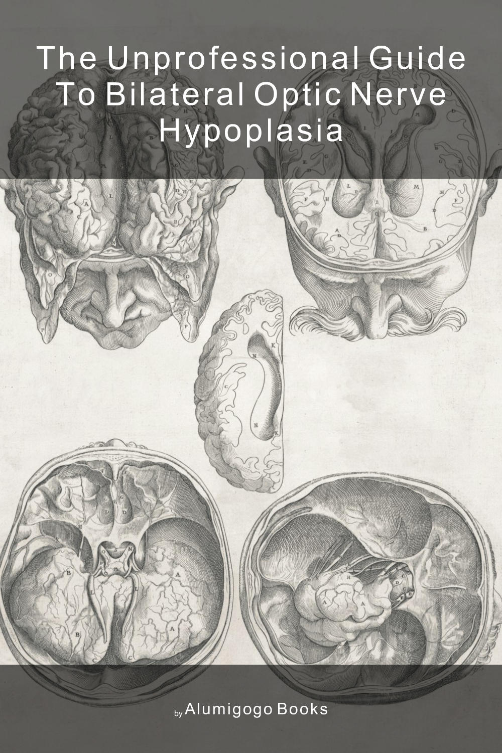 Cover of The Unprofessional Guide to bilateral optic nerve hypoplasia