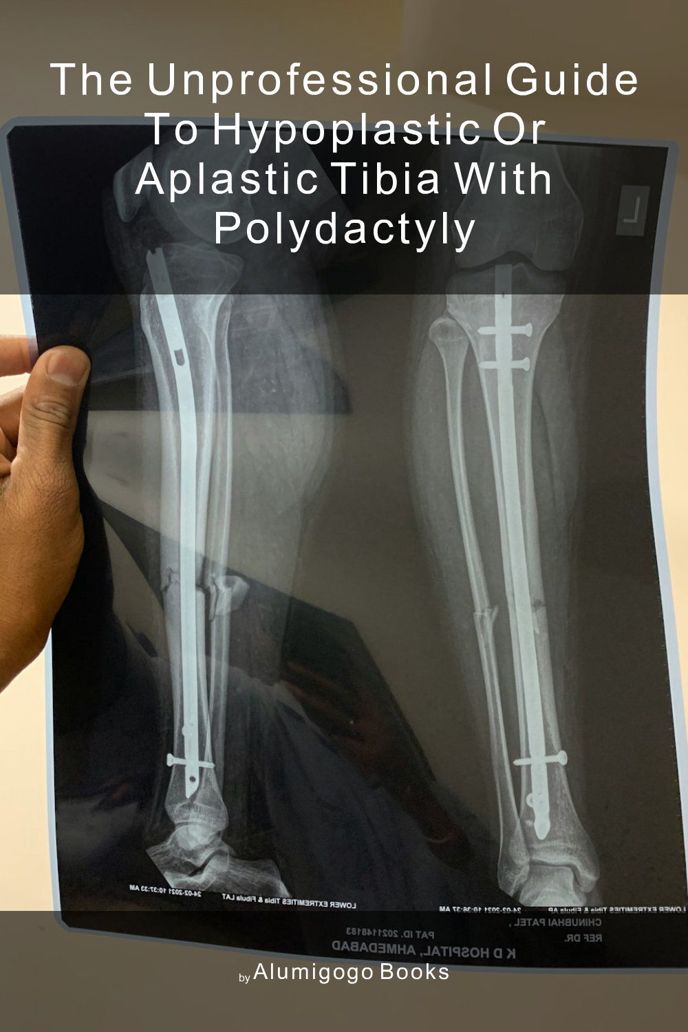 Cover of The Unprofessional Guide to hypoplastic or aplastic tibia with polydactyly