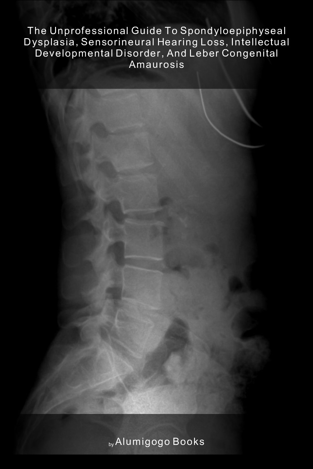Cover of The Unprofessional Guide to spondyloepiphyseal dysplasia, sensorineural hearing loss, intellectual developmental disorder, and Leber congenital amaurosis